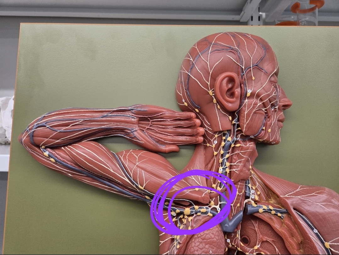 <p><strong>Right lymphatic duct</strong></p><p>Deposits in right subclavian vein </p>