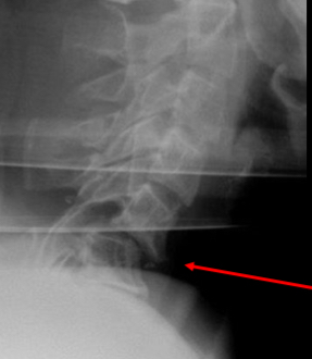 <ul><li><p>flexion/distraction injury with a buckling force</p></li><li><p>Unstable due to complete liagmentous disruption</p></li></ul><p></p>