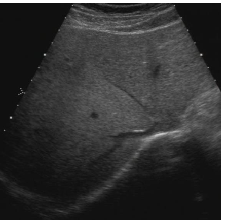 <p>what echotexture is shown?</p>