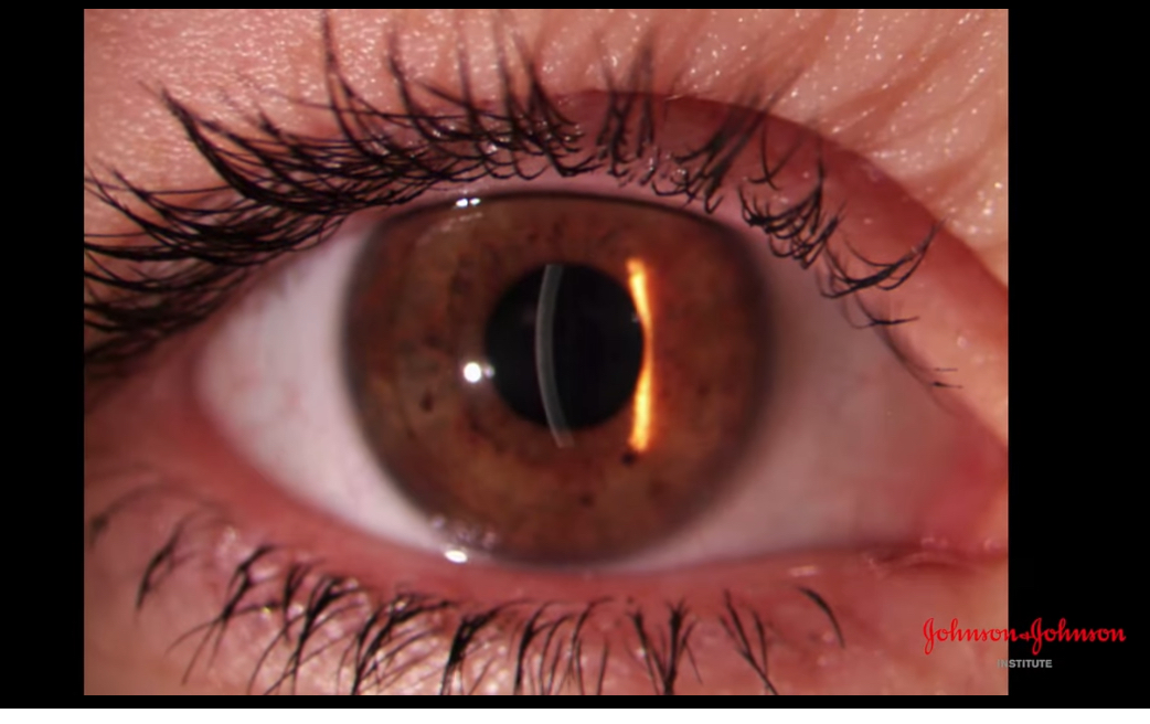 <p>Effective for examine depth of corneal damage </p><p>Remove diffuser </p><p>Thin slit down as much as possible for better resolution </p><p>Increase magnification </p><p>Increase brightness</p><p></p><p>Upper and lower part  is not in focus due to the curvature of cornea </p><p>Reduce height of slit to 3-4 so straighten eye and have all cornea in focus </p><p>Magnify image further whilst focusing it </p><p>Slit width might need adjusting to get bright image </p><p>Increasing angle between illumination system and observation system </p><p>Increasing angle section looks broader </p><p>Reducing angle make sit thinner \increase mag further layers can be seen more clearly </p><p>Move to temporal section of cornea whilst keeping in focus </p><p></p>