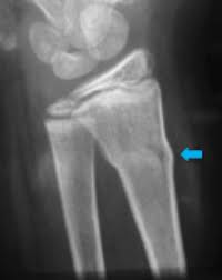 cortex buckles but does not break
