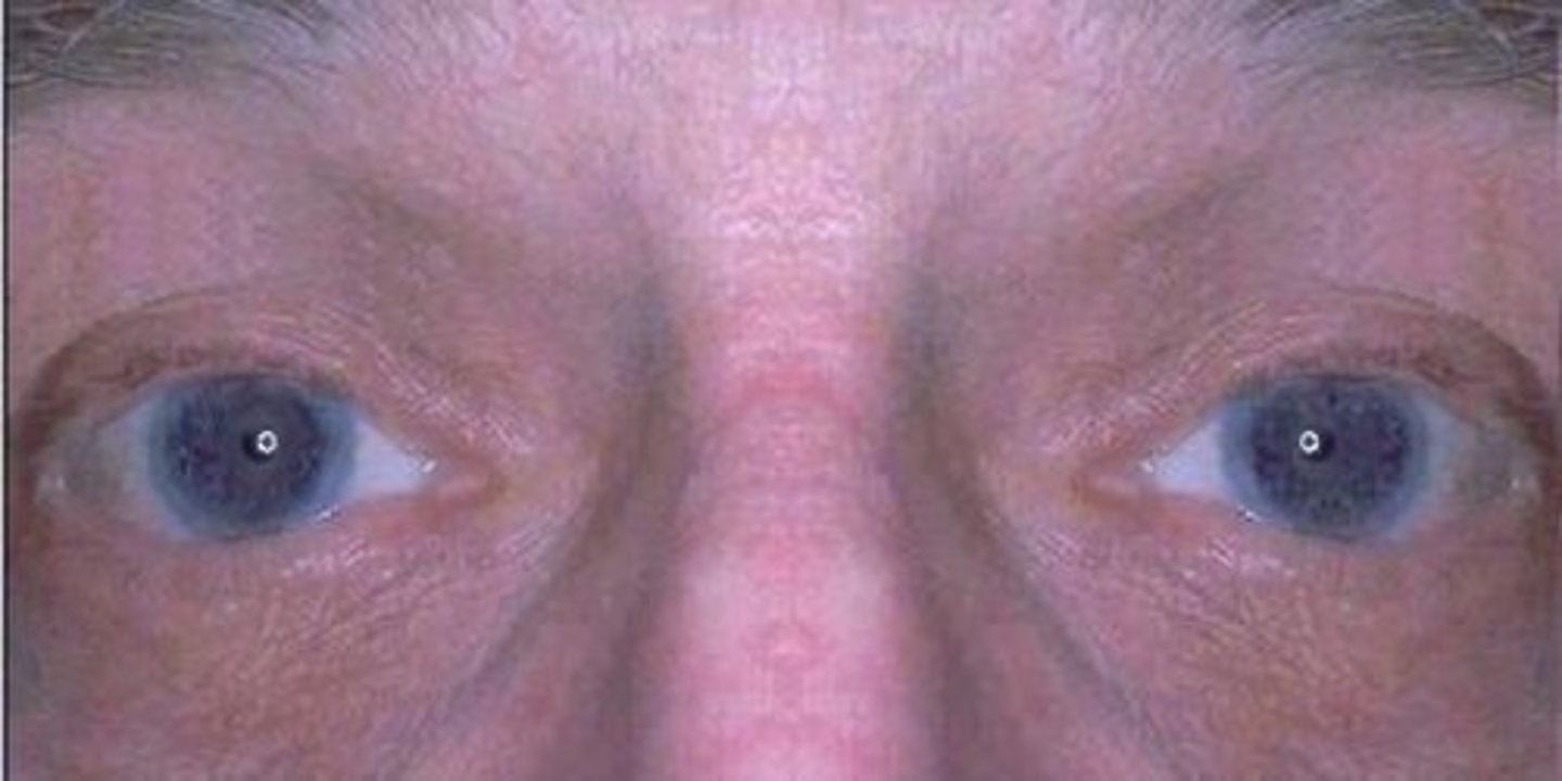 <p>- small irregular pupils (usually bilateral)</p><p>- near reaction and accommodation intact</p><p>- do not react to light</p><p>- seen in (tertiary) neurosyphilis</p>