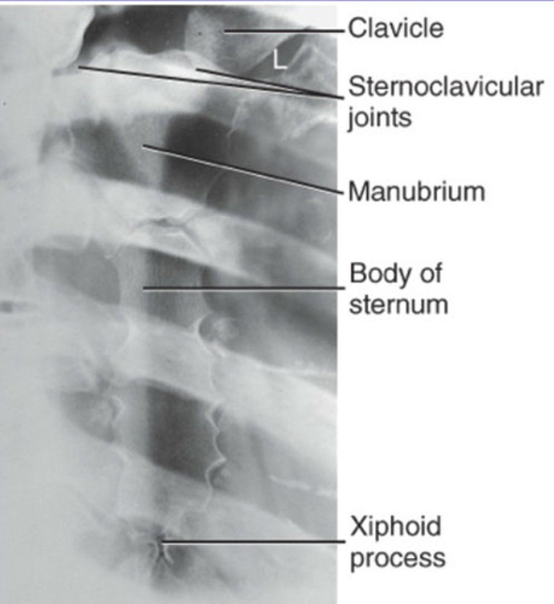 <p>15-20 degree oblique, RAO. Places sternum over heart shadow. Less obliquity is required for larger body habitus.</p>