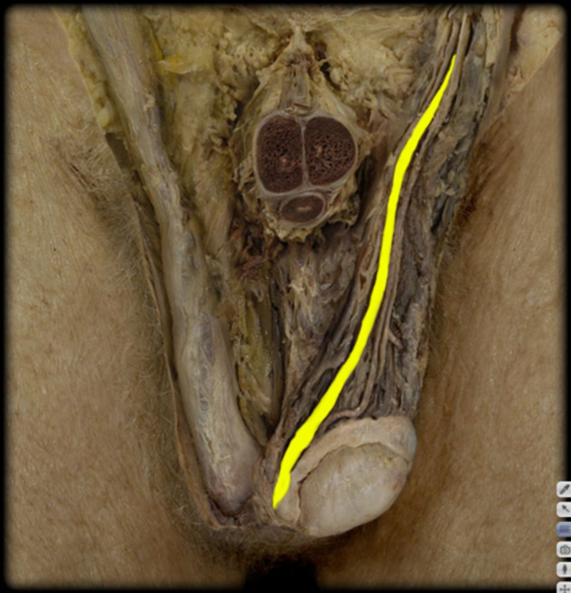 <p>-in spermatic cord</p><p>-travels with testicular a/v</p><p>-inside inguinal canal</p><p>-from epididymis</p><p>-to bladder region</p><p>-cut</p><p>-thicker/rounder than a/v</p>
