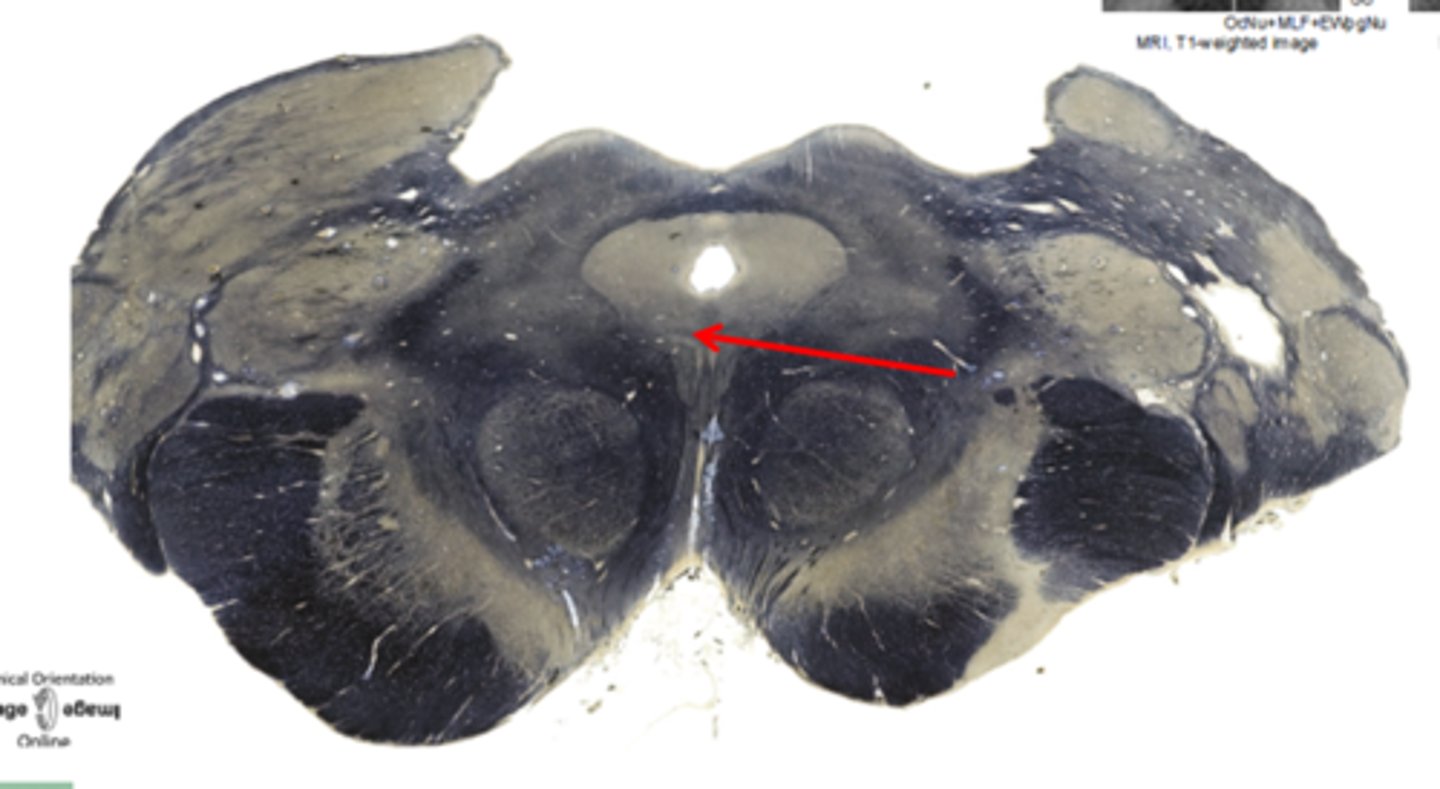 <p>part of oculomotor complex controlling ciliary muscle for accommodation of the lens &amp; pupil constriction</p>