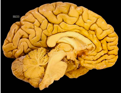 <p>Surrounding the thalamus area</p>