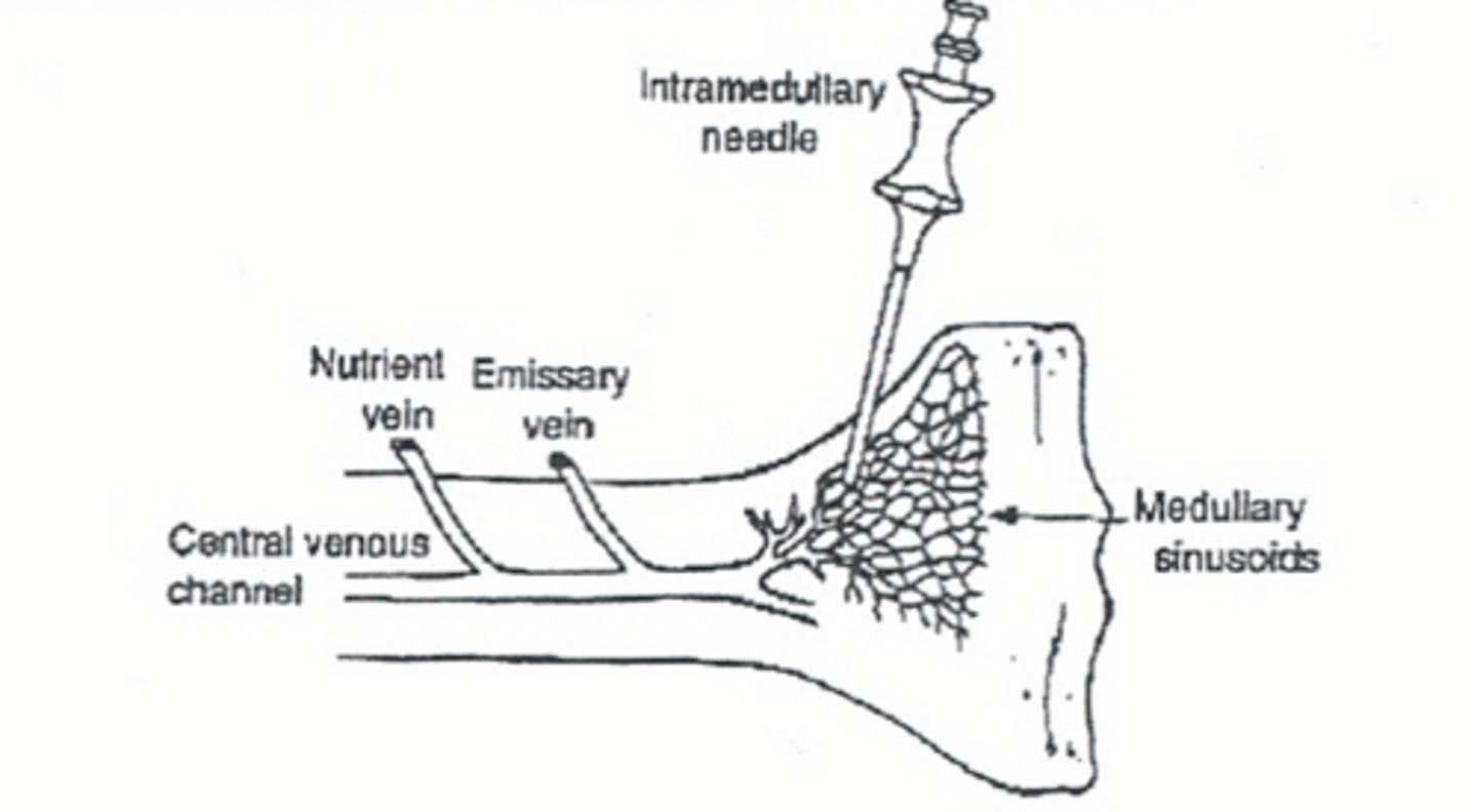 <p>-Emergency "venous" access</p><p>-Provides rapid access only when a peripheral line not available</p><p>-Can administer any fluid, bloods, or medications (except adenosine)</p>