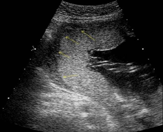 <p>what are the arrows pointing to</p><p>a) hematoma formation w/placental abruption</p><p>b) normal retroplacental space</p><p>c) amnion + chorion junction</p><p>d) placental lake formation posterior to the placenta</p>