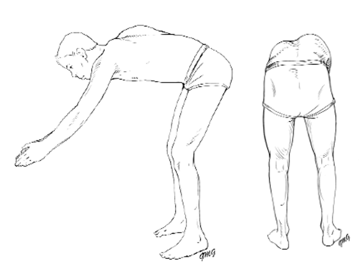 <p>Bend forward at waist until spine becomes parallel to the floor while holding palms together with arms extended.</p><p>Examine child from behind and side looking for asymmetry in the contour of the back (rib hump)</p><p>Flexibility should also be evaluated by stabilizing the spine and asking the child to twist to both sides</p><p>Ninety percent of curves are to the right, left thoracic concerning</p>