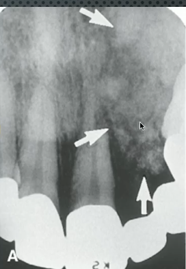 <p>INVASIVE, mixed RL/RO, EXPANSILE, root resorption and displacement</p>