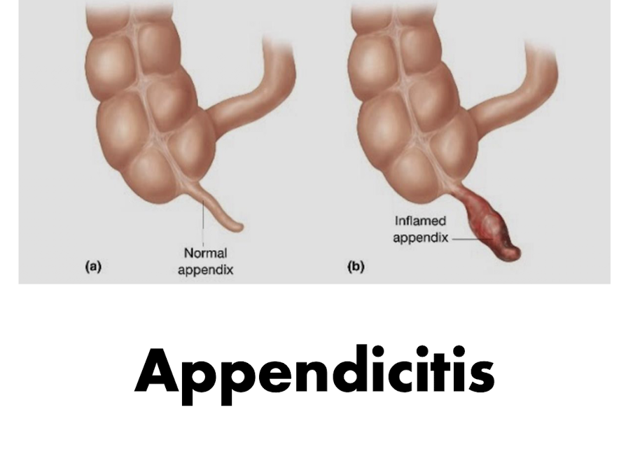 <p>Appendicitis:</p><ul><li><p>What type of referral?</p></li><li><p>What is the Tx?</p></li></ul><p></p><p></p>