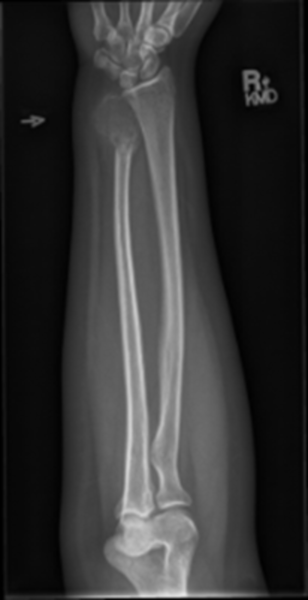 <p>-Entire forearm(include wrist and distal humerus)</p><p>-slight superimposition of Radial head/neck/tuberosity over proximal ulna</p><p>-No elongation by seeing both epicondyles</p><p>-partially open elbow joint (arm on same plane)</p><p>-open radioulnar space</p>