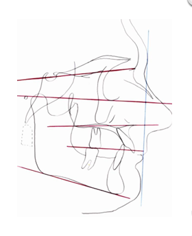<p>-skeletal pattern in which the skeletal planes are more parallel to each other</p><p>-characterized by a low mandibular plane angle, short lower facial height, and is often associated with class II division 2 malocclusions and deep bites</p><p>-tend to have a very square face</p>