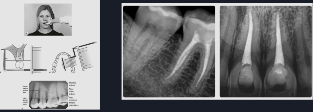 <p>Periapical X-rays </p>