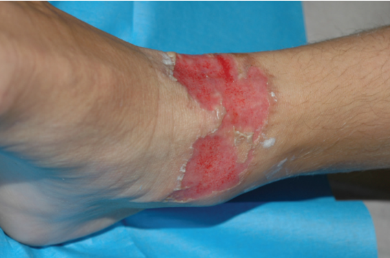 <ul><li><p>Partial Thickness</p></li><li><p>Epidermis + upper dermis</p></li><li><p>10-14 days healing</p></li><li><p>Very painful</p></li></ul><p></p>