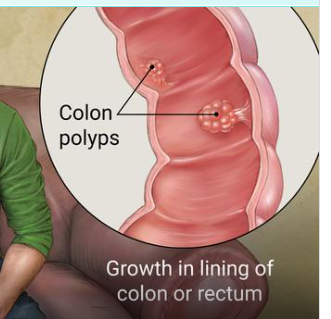 <p><span style="font-family: Droid Sans Mono, monospace">COLONIC POLYPOSIS</span></p>