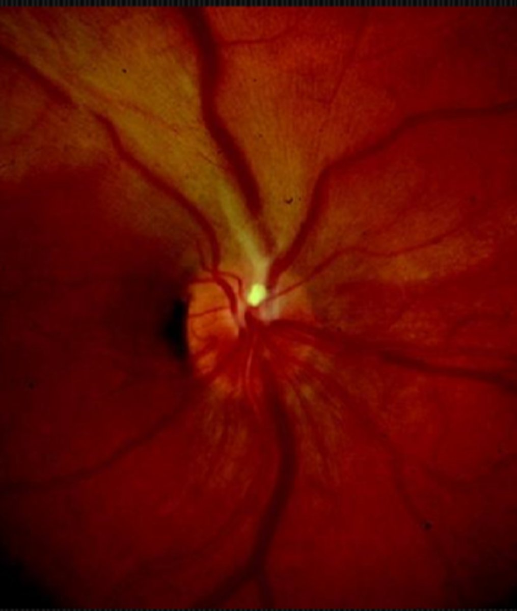 <p>amaurosis fugax of CV disease = unilateral</p><p>vertebral basilar insufficiency = bilateral</p><p>visual obscurations = momentary brown outs or blur outs of vision due to disc edema</p><p>classic migraine prodrome (younger pt, w/ flashing lights, nausea, emesis, head pain)</p>