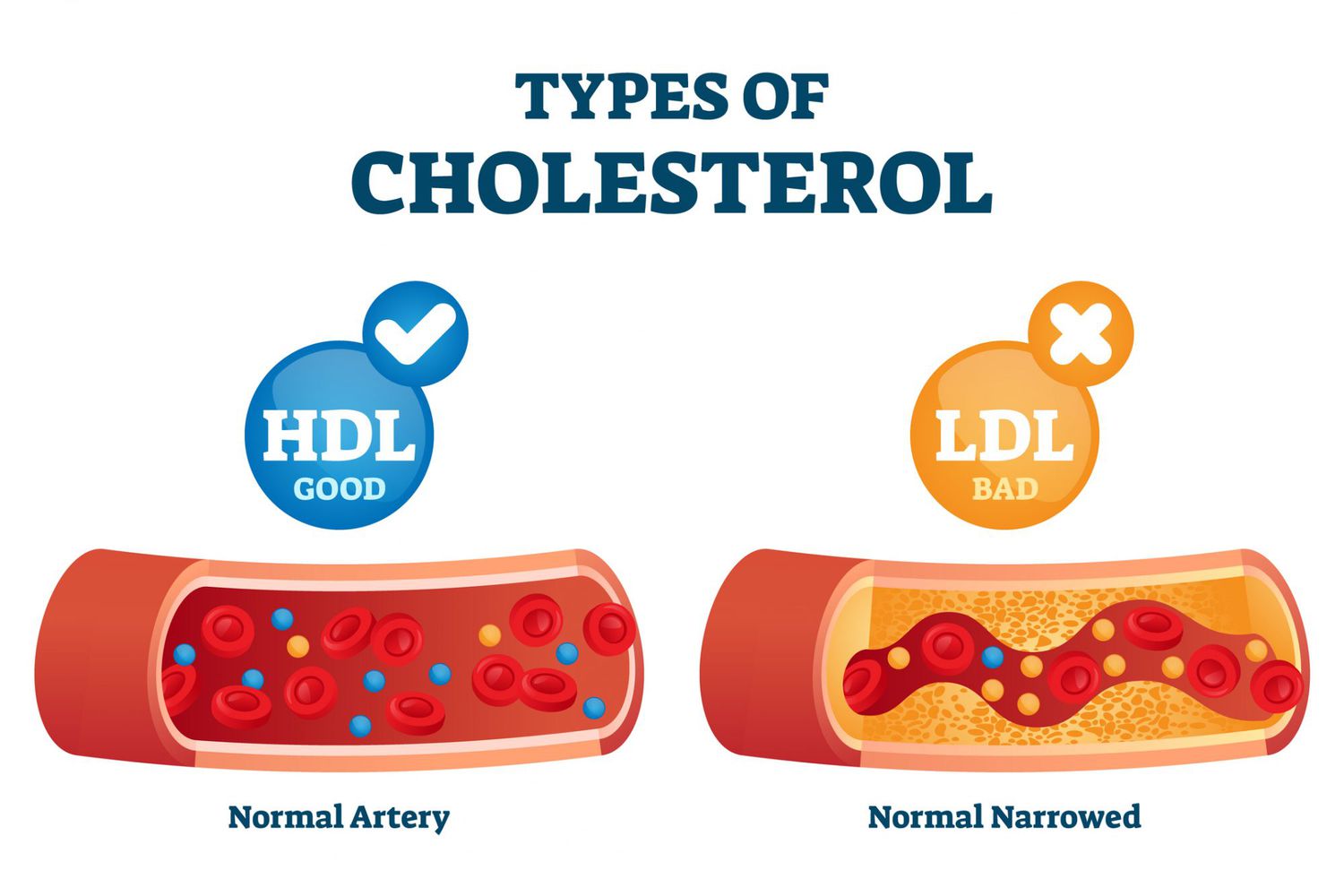 <p>bad cholesterol</p>