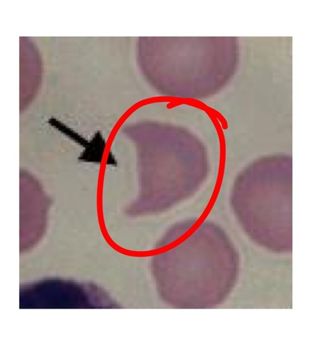 <p>blister rupture of membrane</p><p>- G6PD deficiency</p><p>- pulmonary embolism</p>