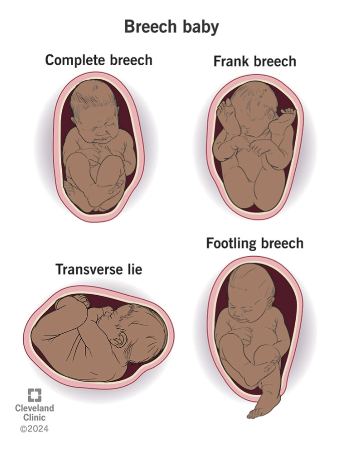 <ul><li><p>Head entrapment may occur and birth injuries and oxygen deprivation is more common</p><ul><li><p>Exception being a second twin&nbsp;</p></li></ul></li></ul><p></p>