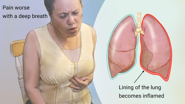 <p>C) Pleuritis related to infection</p><p><strong>Feedback: Pleuritis, which frequently accompanies infections that cause cough, is unilateral, starts abruptly, and is worsened by coughing or deep breathing. The client's shallow, rapid breathing may be due to anxiety but also is a way of maintaining adequate air intake while avoiding deep breathing, which exacerbates the pain of pleuritis. His cough may be an indication of infection, especially as he is not a smoker. The pain of myocardial infarction is not worsened by deep breathing or coughing. Spontaneous pneumothorax would be very unlikely in a short, nonsmoking middle-aged man. Tachypnea might indicate obstructive atelectasis, but normal breath sounds and lack of cyanosis argue against it.</strong></p>