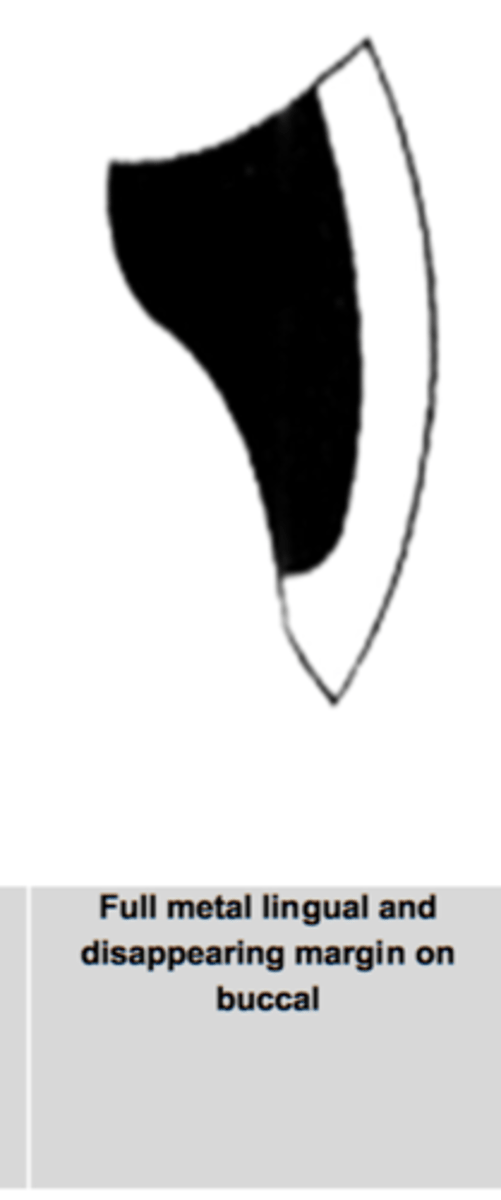 <p>what PFM margin has a combination of metal and porcelain that should have a 120 degree sloped shoulder margin<br><br>- usually on the buccal to conceal the metal portion of a PFM</p>