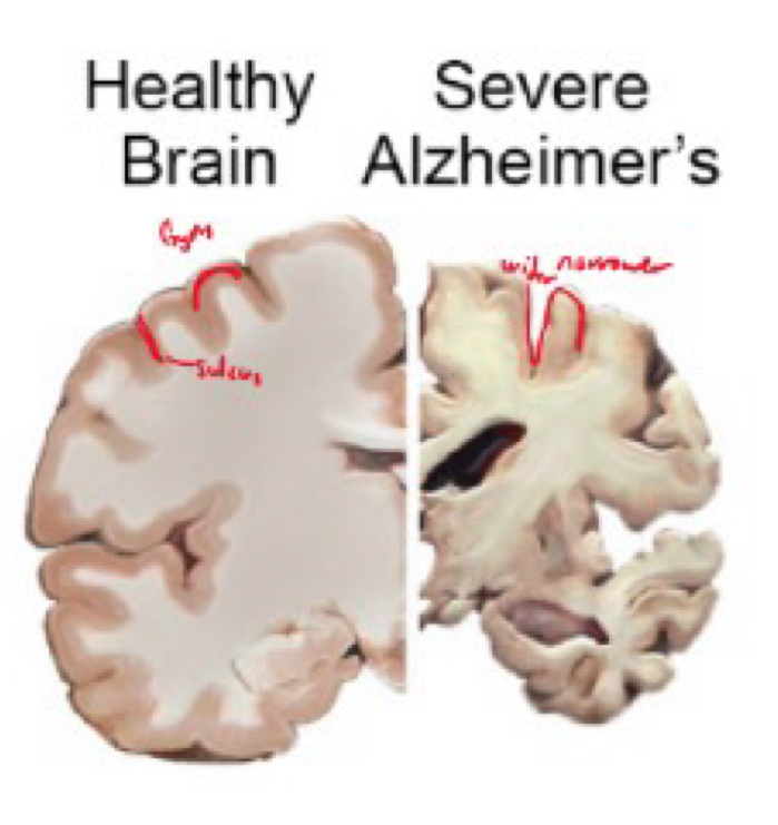 <p>loss of neurones from cerebral cortex, loss of neurotransmitter acetycholine </p><p>forms plaques and tangles in brain, gyri narrower, sulci wider</p><p>SYMPTOMS</p><ul><li><p>cognitive functions impaired </p></li><li><p>impaired memory</p></li><li><p>inability to make logical decisions</p></li></ul>