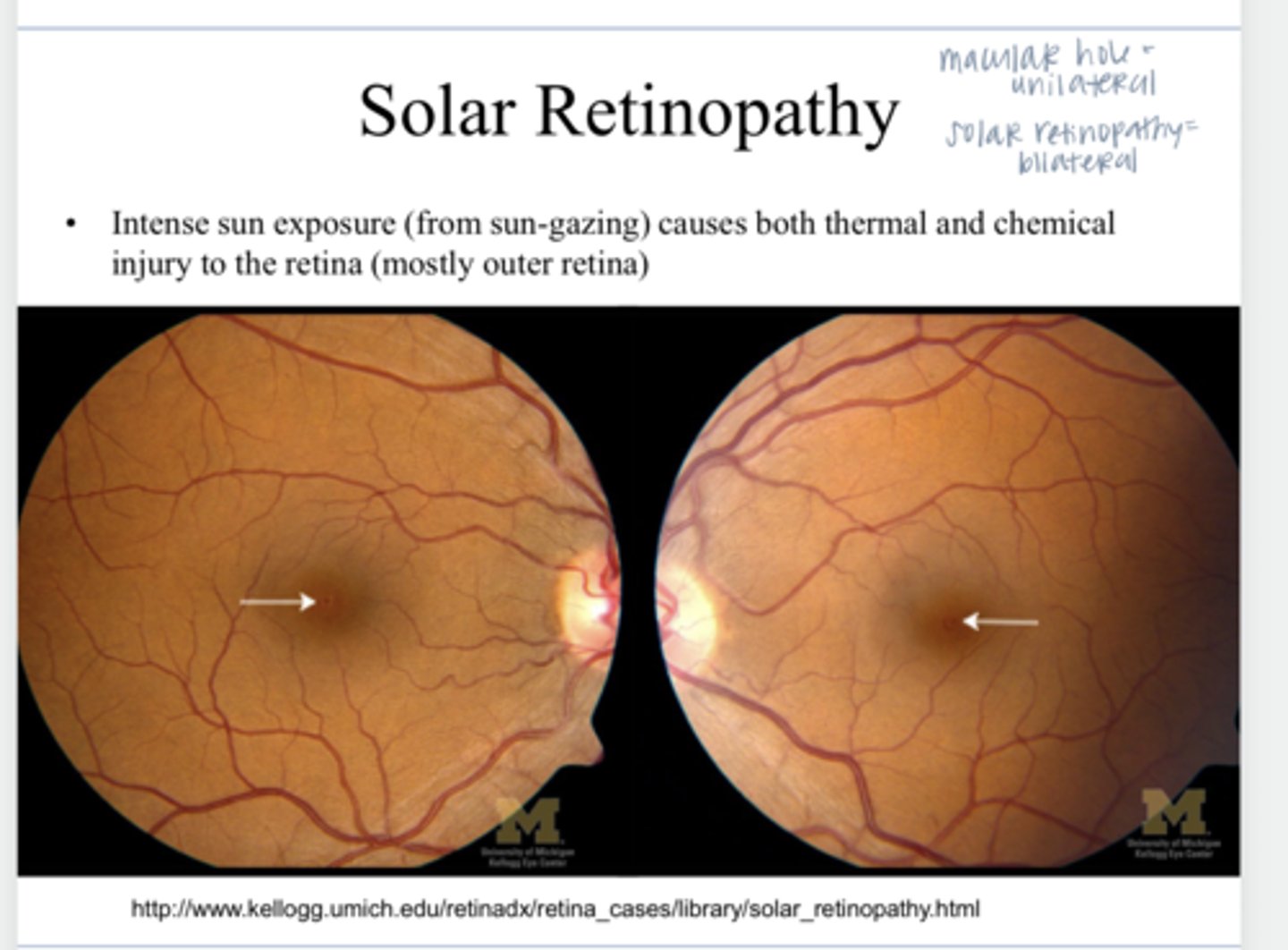 <p>Intense sun exposure (from sun-gazing) causes both thermal and chemical injury to the retina (outer)</p>