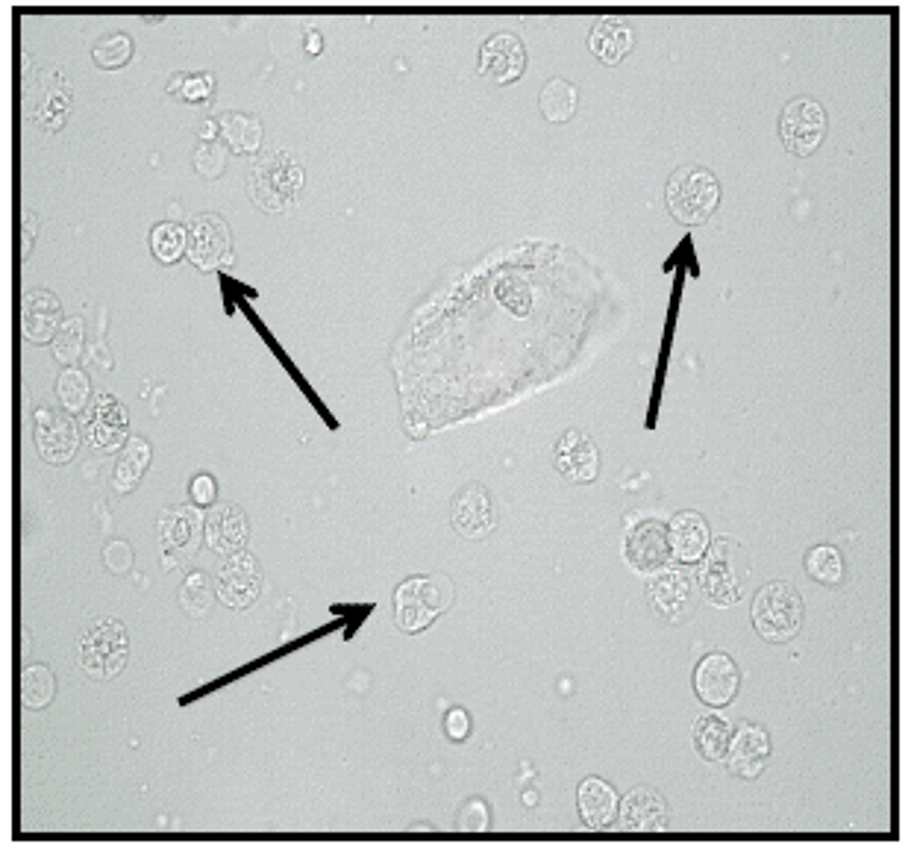<p>WBCs in hypotonic urine</p>