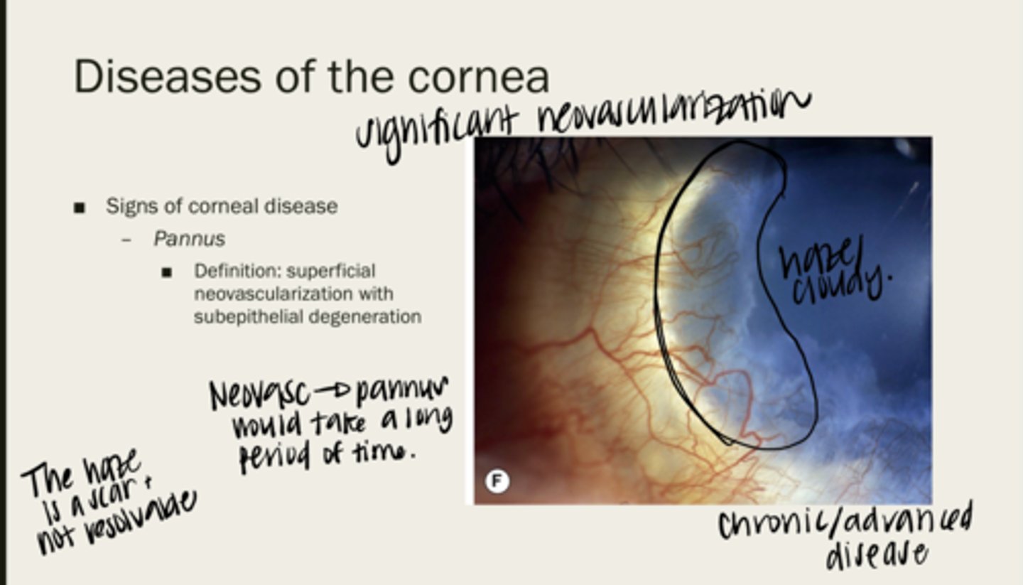 <p>superficial neovascularization with subepithelial degeneration</p>
