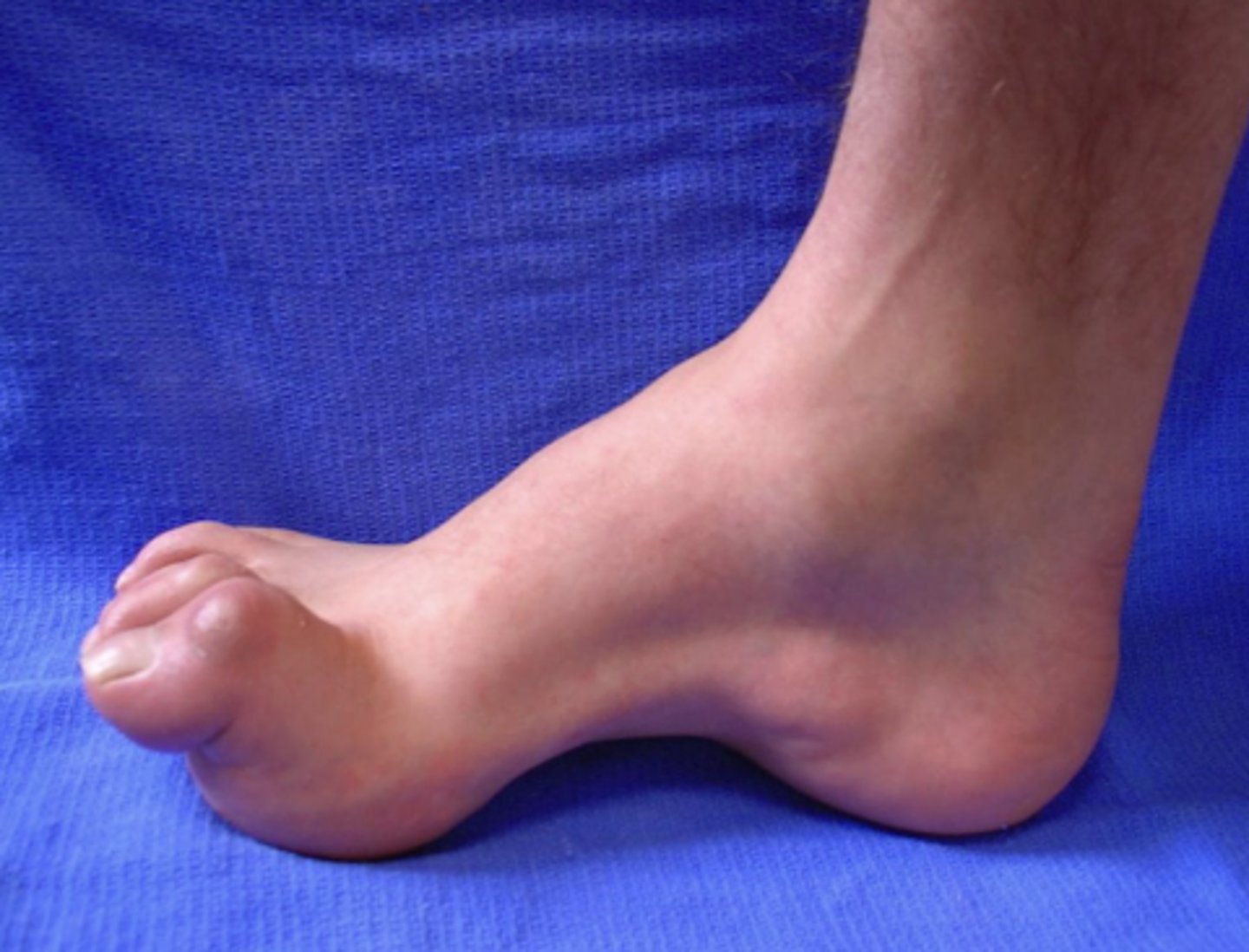 <p>High arches, hammer toes, distal atrophy, foot drop, and hyporeflexia or areflexia.</p>
