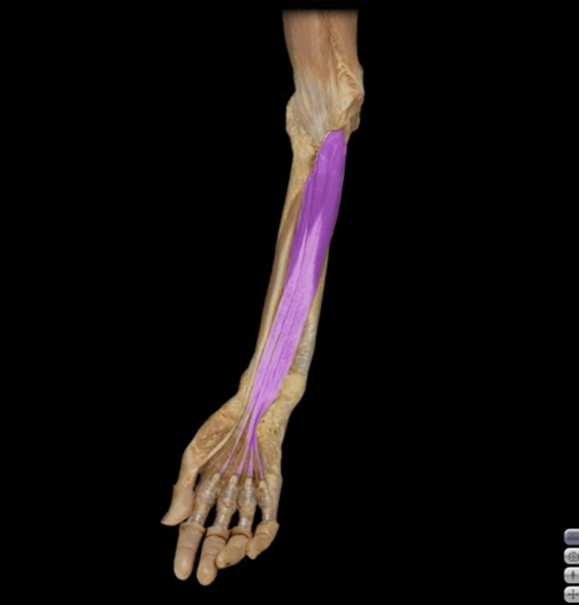 <p>Action: Digit 2-5 flexion at DIP joint</p><p>Origin:</p><p>- Proximal three quarters of anteromedial surface of</p><p>ulna and interosseous membrane</p><p>Insertion: Base of distal phalanges</p><p>Nerve innervation:</p><p>Digits 2&amp;3: AIN of median nerve</p><p>Digits 4&amp;5: Ulnar nerve</p>