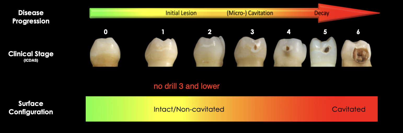 <ul><li><p>ICDAS 1-3 initial lesion → if active → sealant/ SDF = noninvasive or resin infiltration = microinvasive </p></li><li><p>ICDAS 3-4 microcavitation → usually resin infiltration bec microcavitated&nbsp;</p></li><li><p>ICDAS 5-6 Cavitated → SDF or restorative treatment</p></li></ul><p></p>