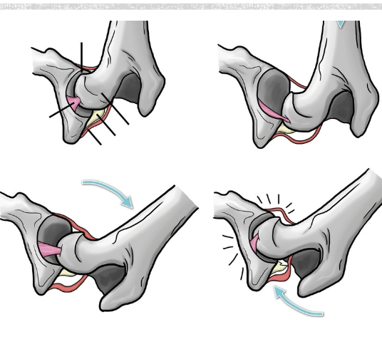 <p>Pain elicted during palpatation/ extension of hips</p><p>Loss of muscle mass</p><p>Ortolani sign (clunk)</p>