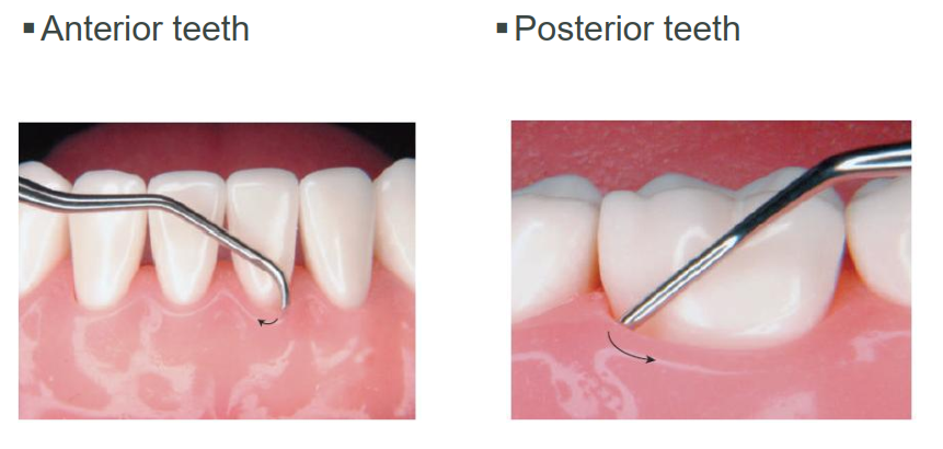 <p>Horizontal strokes below gingival margin → especially useful for deposits near distofacial/distolingual line angle of posterior teeth AND midline of facial/lingual surfaces of anterior teeth. </p>