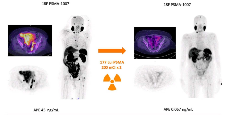 <p><u>Exemple d’un patient :</u> Il a eu une première image avec du PSMA marqué au fluor 18 pour faire de l’imagerie. On peut voir les tumeurs.</p><p>Ensuite, il y a eu<strong> 2 cycles</strong> avec du PSMA radiomarqué avec du Lutécium 177 pour faire de la radiothérapie interne vectorisée.</p><p>Puis il a eu a nouveau une imagerie de contrôle avec du PSMA marquée au Fluor 18 et là on ne voit pratiquement rien, on n’a donc une destruction totale des tumeurs par les 2 cycles de traitement !</p><p><em>+ Antigènes de la prostate sont diminués</em></p><p></p>