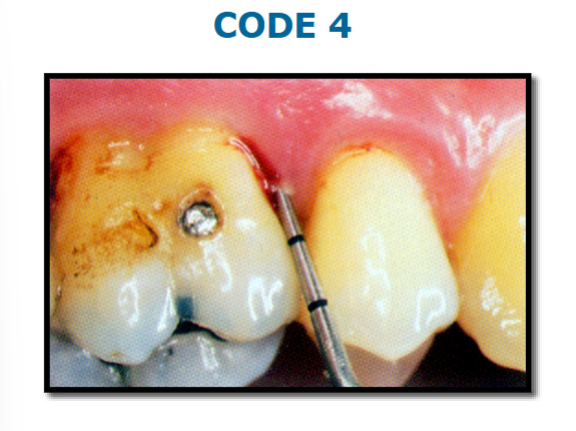 <p>colored area of probe completely disappears, probing depths >5.5</p>