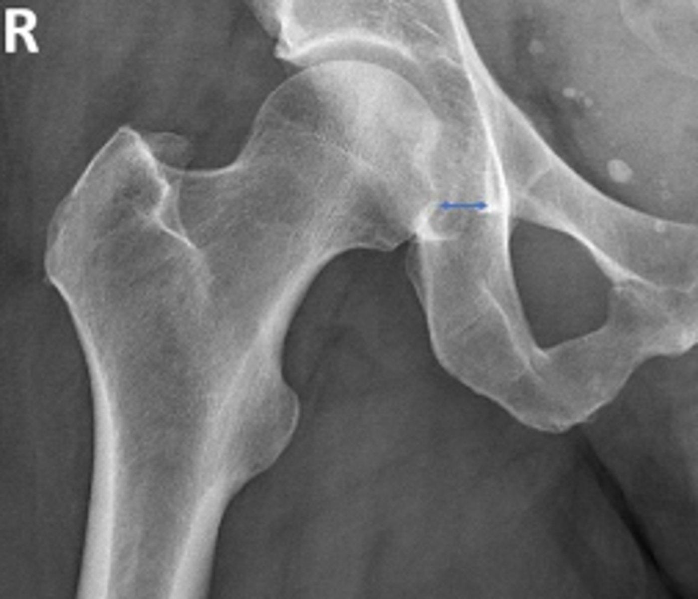 <p>Name 2 conditions that may result in a measurement of 3mm?</p>