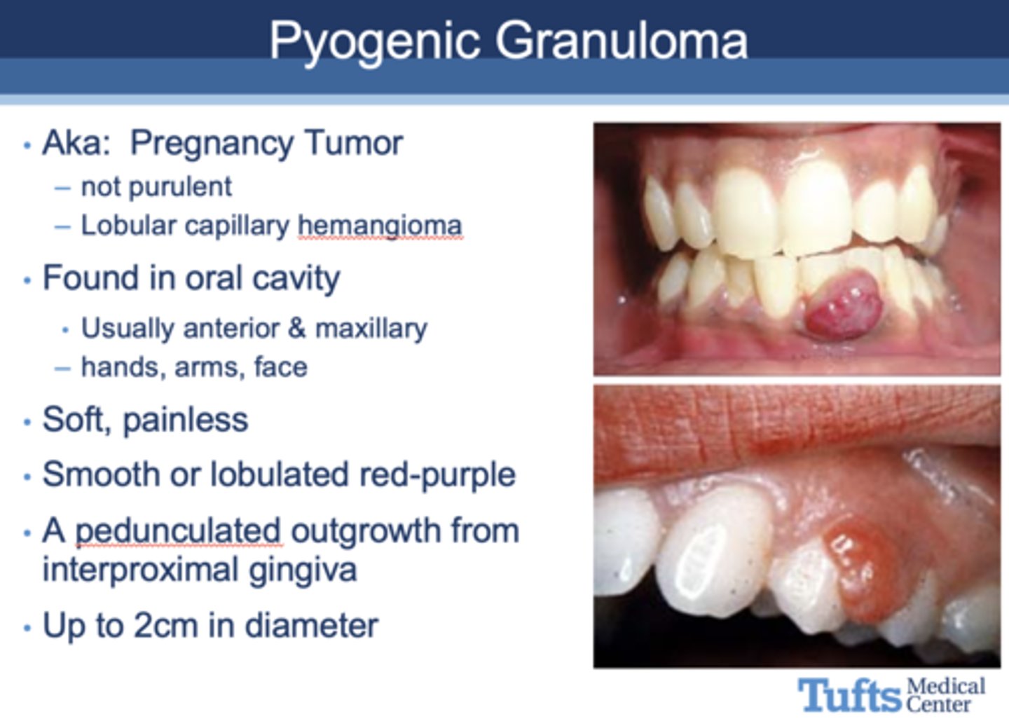 <p>Pyogenic granuloma</p>