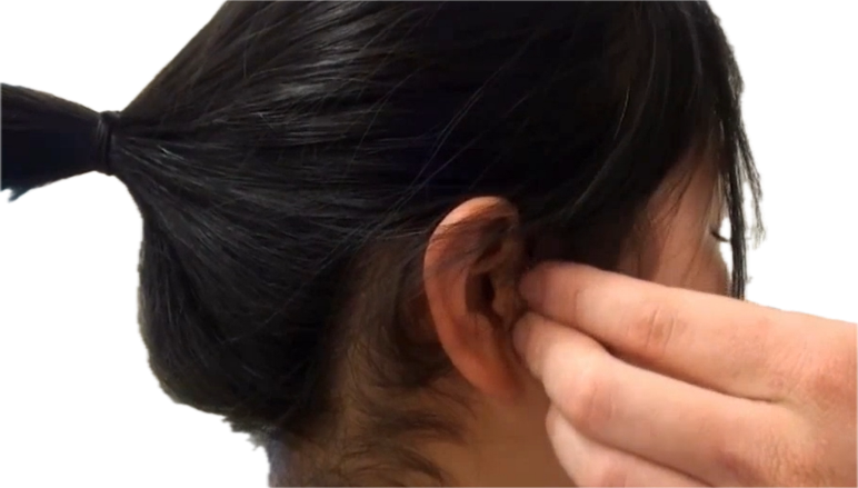 <p>Preauricular (front of ear - both sides)</p>