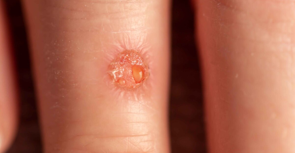 <p>Buildup of serous fluid</p>