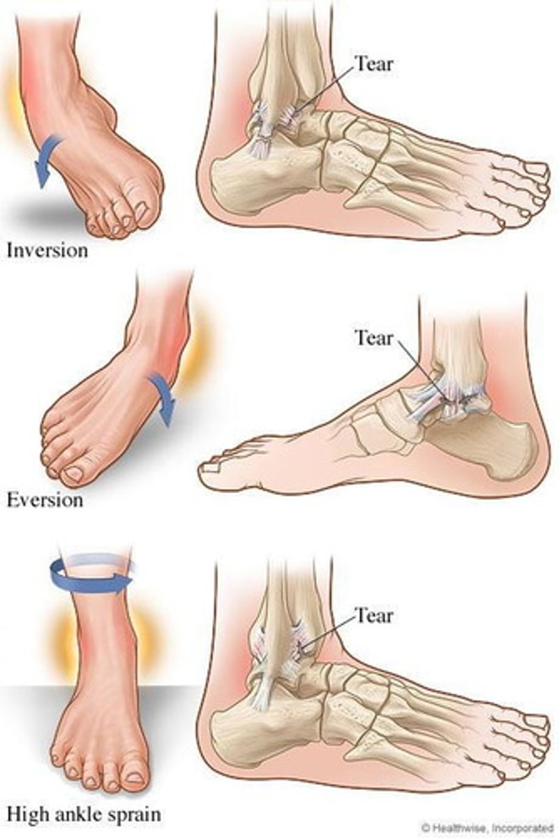 <p>Movement of sole of foot outward</p>