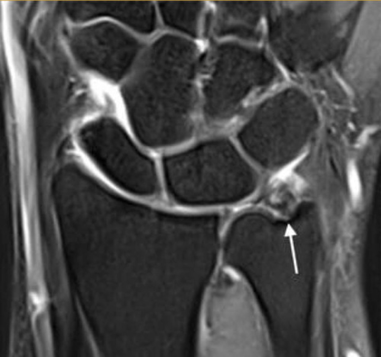 <p>May lead to ulnar abutment (impaction) of the lunate and TFCC (triangular fibrocartilage complex) degeneration</p><p>May be associated with triangular fibrocartilage tear</p>