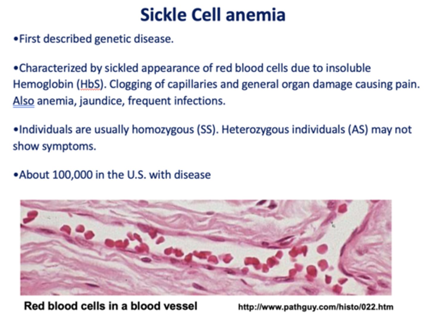 <p>sickle cell anemia</p>