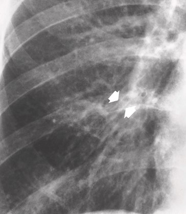 <p>this is chronic bronchitis, what is the RA</p>