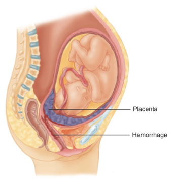 <p>Placenta previa </p>