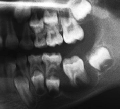 <p>What is a common radiographic feature of buccal bifurcation cyst?</p>