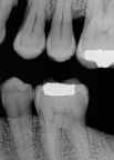 <p>A bitewing image oriented vertically, used to examine alveolar bone levels (especially in periodontal patients).</p>