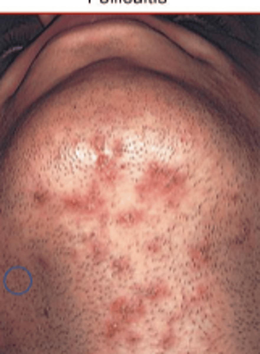 <p>papule formed around single central hair follicle</p>