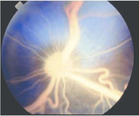 <p>typically noticed after 6-9months of age</p><p>peripheral neuropathies, cutaneous xanthomas, formation of lipid granulomas. </p><p>Most affected kittens do not show clinical signs OTHER THAN LIPEMIA RETINALIS</p>